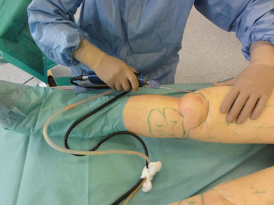 Aufnahme eines operativen Eingriffs zur Behandlung einer Fettverteilstörung im Kniebereich