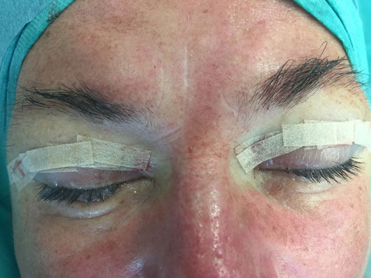 Nahaufnahme der Augenpartie einer Frau, nach einer Augenlidstraffung, die noch nicht ausgeheilt ist