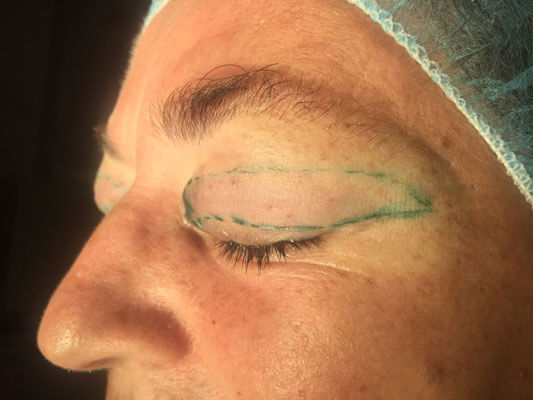 Bild der gekennzeichneten Augenpartie, die durch Augenlidstraffung angehoben werden soll