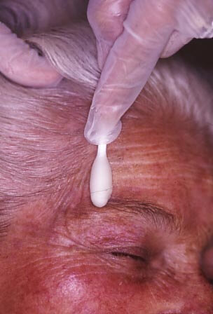 Anwendung eines chemischen Peelings an einer älteren Frau im Augenbrauenbereich