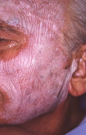 Abbildung der weißlich verfärbten Gesichtshaut in Folge der Anwendung eines chemischen Peelings