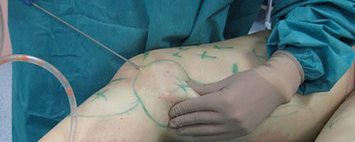 Bild eines nackten Beines, bei der Behandlung im Rahmen einer Fettabsaugung