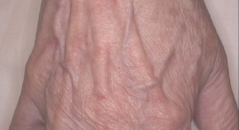 age spots after IPL Therapy
