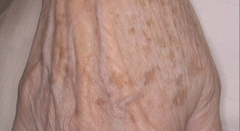 age spots before IPL Therapy