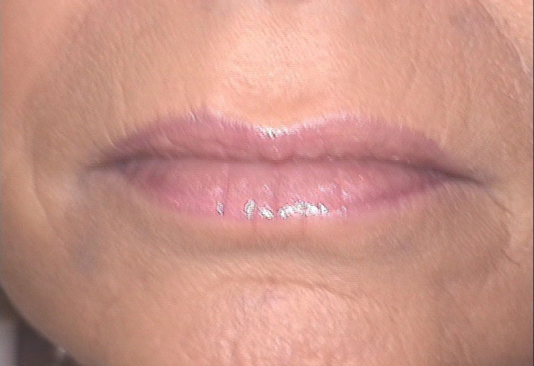 After treatment with hyaluronic acid filler