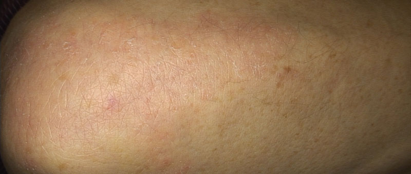Psoriasis after topical treatment
