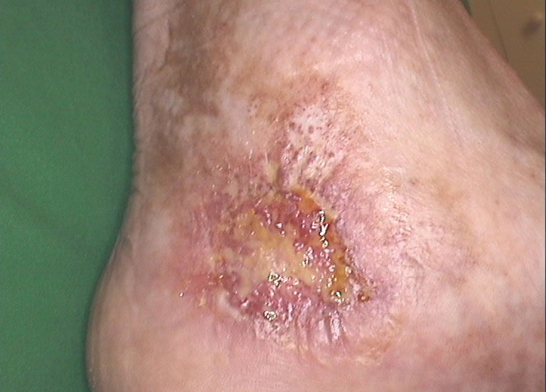 Ulcus cruris before therapy