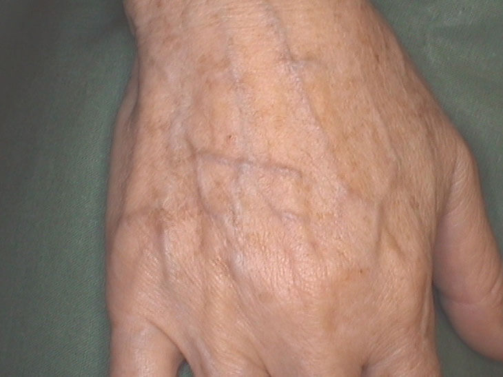 After foam sclerotherapy of the veins