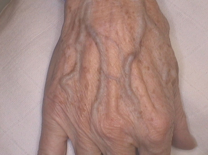 Before foam sclerotherapy of the veins
